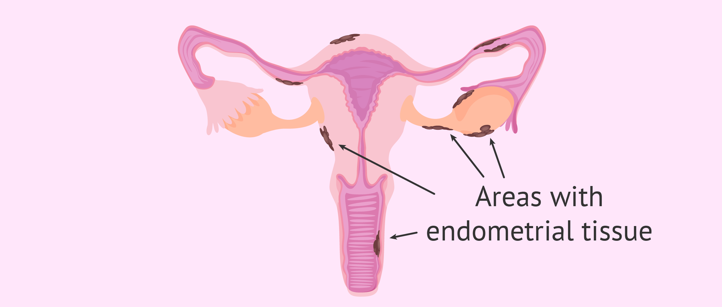 adenomiosis-endometriosis