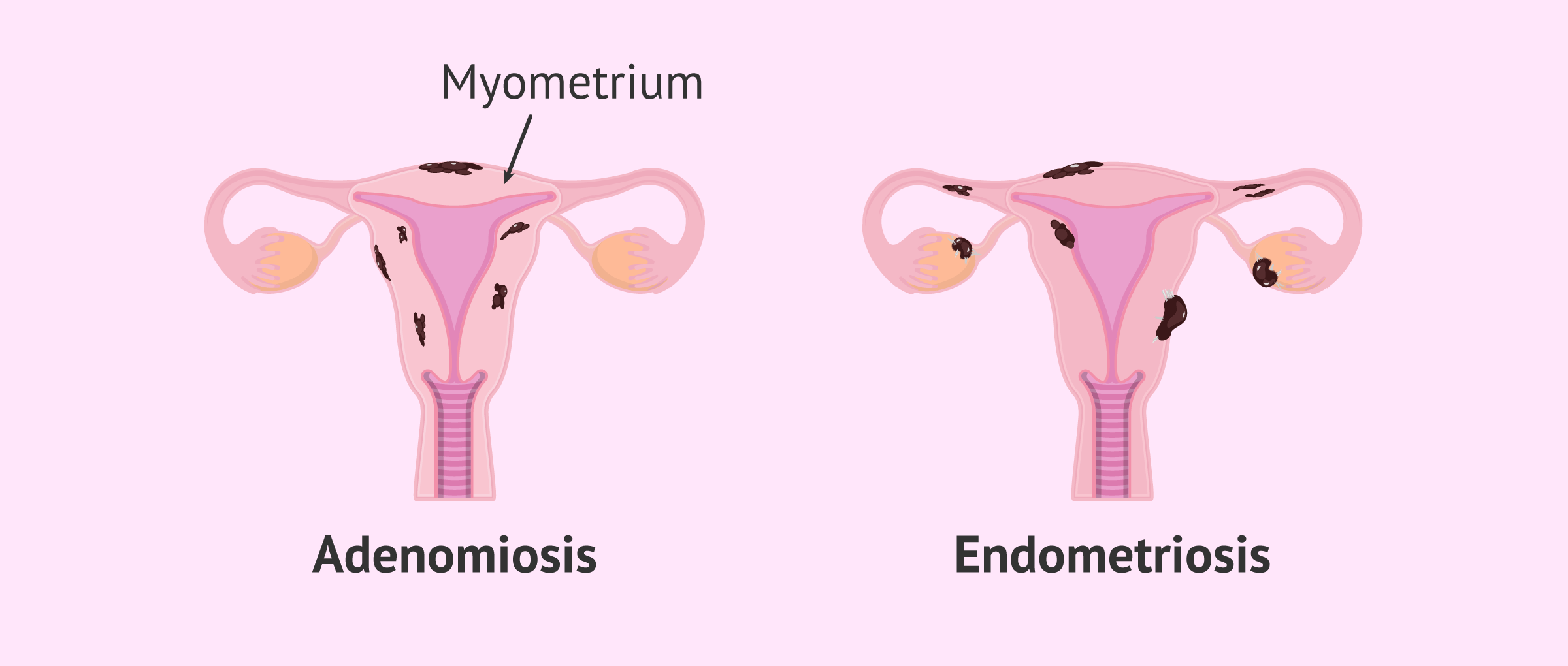 adenomiosis-endometriosis